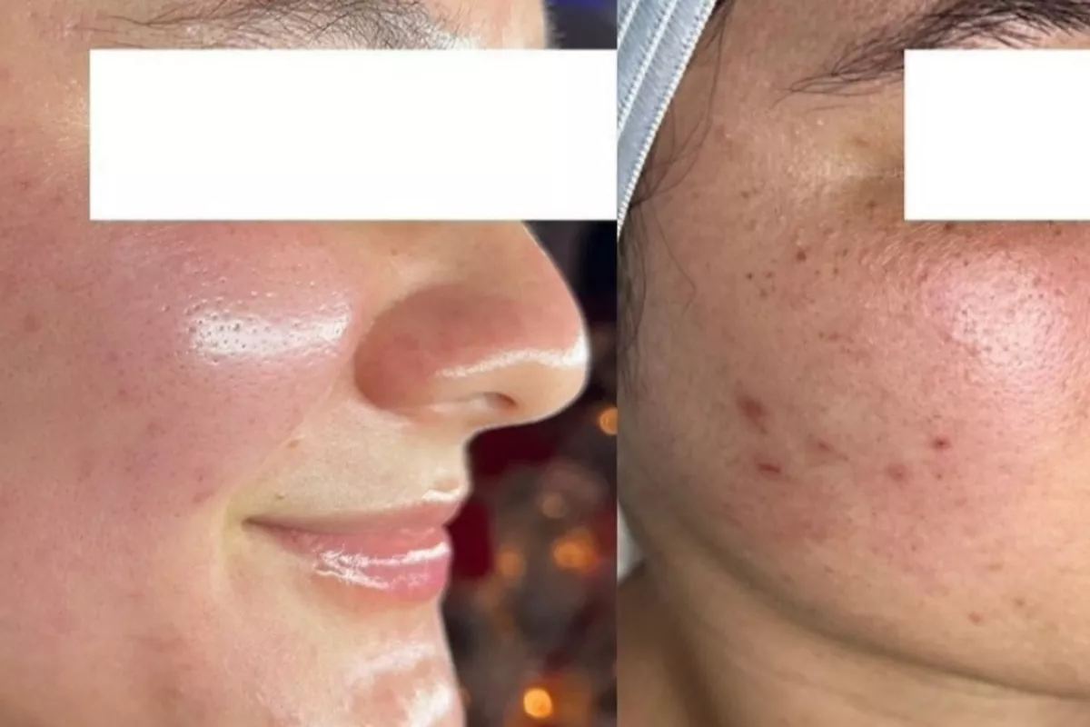 Hydrafacial Anti-Acné – Soin purifiant et réparateur