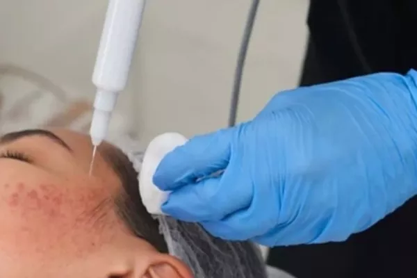 Plasma Froid Acné visage