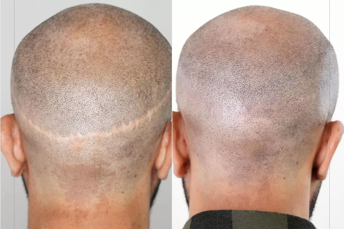 Experte en dermopigmentation réparatrice, je me spécialise dans le microblading, une technique de pigmentation semi-permanente des sourcils qui permet de redessiner et de sublimer naturellement le regard. Cette méthode de précision est idéale non seulement pour celles et ceux souhaitant corriger ou densifier leurs sourcils de manière subtile et harmonieuse, mais aussi pour les femmes et les hommes ayant subi une chimiothérapie ou souffrant d’alopécie. Mon approche est centrée sur le respect des traits uniques de chaque client, pour un résultat qui allie esthétique et naturel. Je travaille avec des pigments de qualité médicale, garantissant une tenue durable et un effet qui ne vire pas avec le temps. Mon objectif est de redonner confiance en soi et de mettre en valeur la beauté naturelle, avec des sourcils sur mesure qui répondent aux besoins individuels de chacun. Saint-Gratien