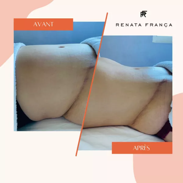 Drainage lymphatique post-opératoire