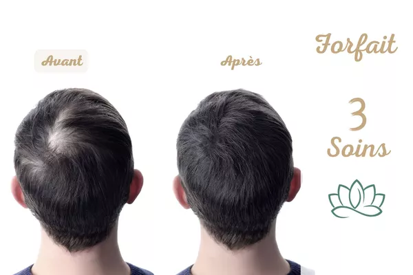 Forfait 4 à 8 soins capillaires HR3 Matrix