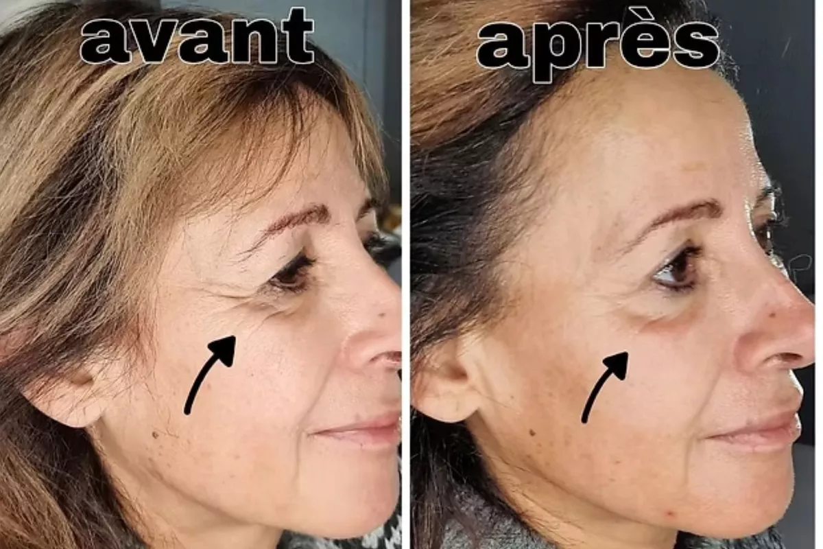 Microneedling Bois-Guillaume