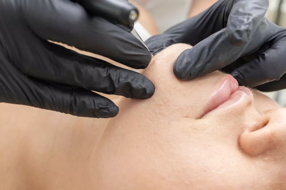 Epilation Menton