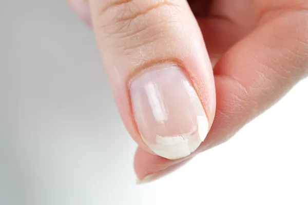 Ongle cassé 