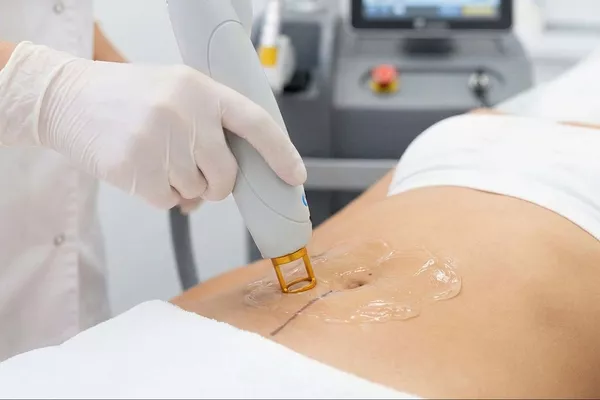 Épilation laser Ligne du nombril