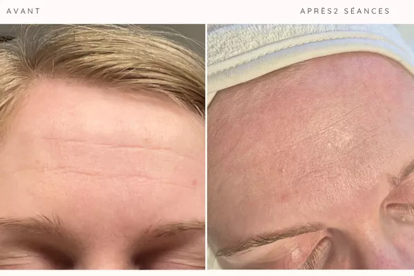 Plasma Froid Russe visage 1 zone au choix (hors paupière)