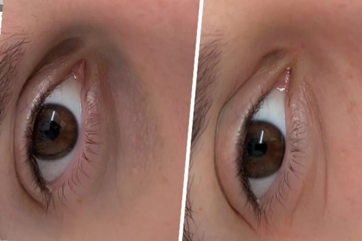 Dermoreconstruction-cernes, cicatrice et vergeture