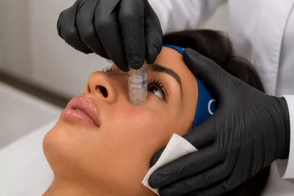 NANONEEDLING Botox