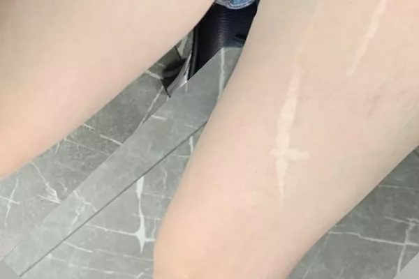 Dermoreconstruction-cernes, cicatrice et vergeture