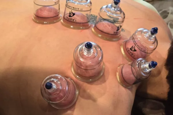 Cupping Ventouses Sèches