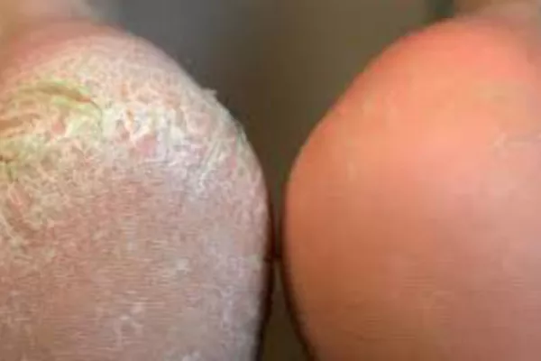 Callus Peel + beauté des pieds