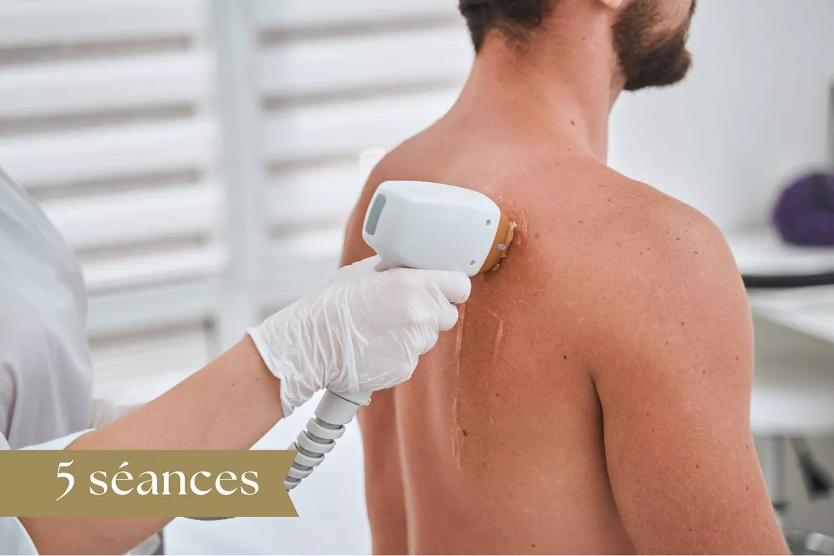 Forfait Épilation Laser Homme 5 séances - Dos entier
