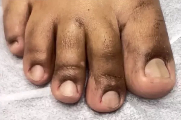 PEDICURE
