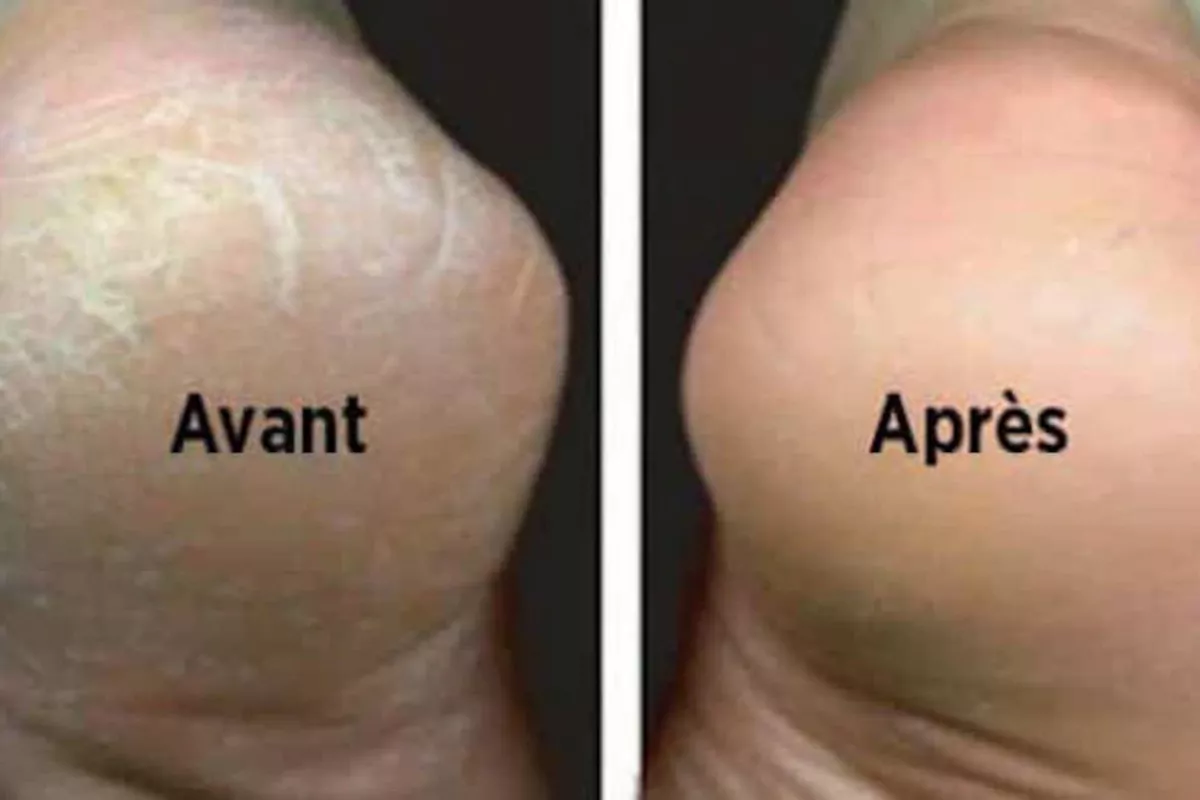 peeling des pieds