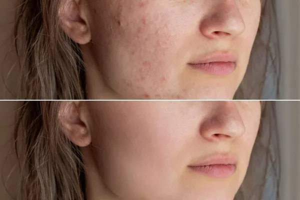 AMTS/ Traitement spécifique des cicatrices & cicatrices d'acné