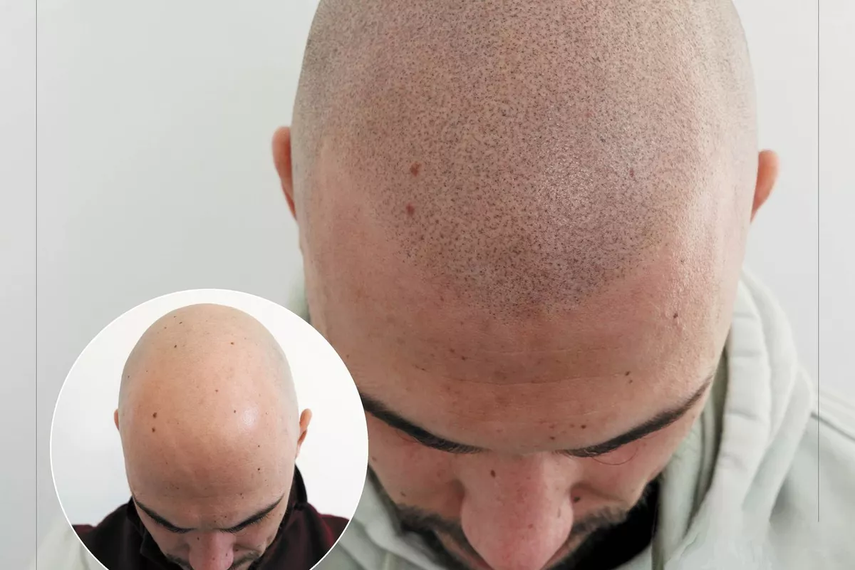CAPILAIRE OU TRICOPIGMENTATION
