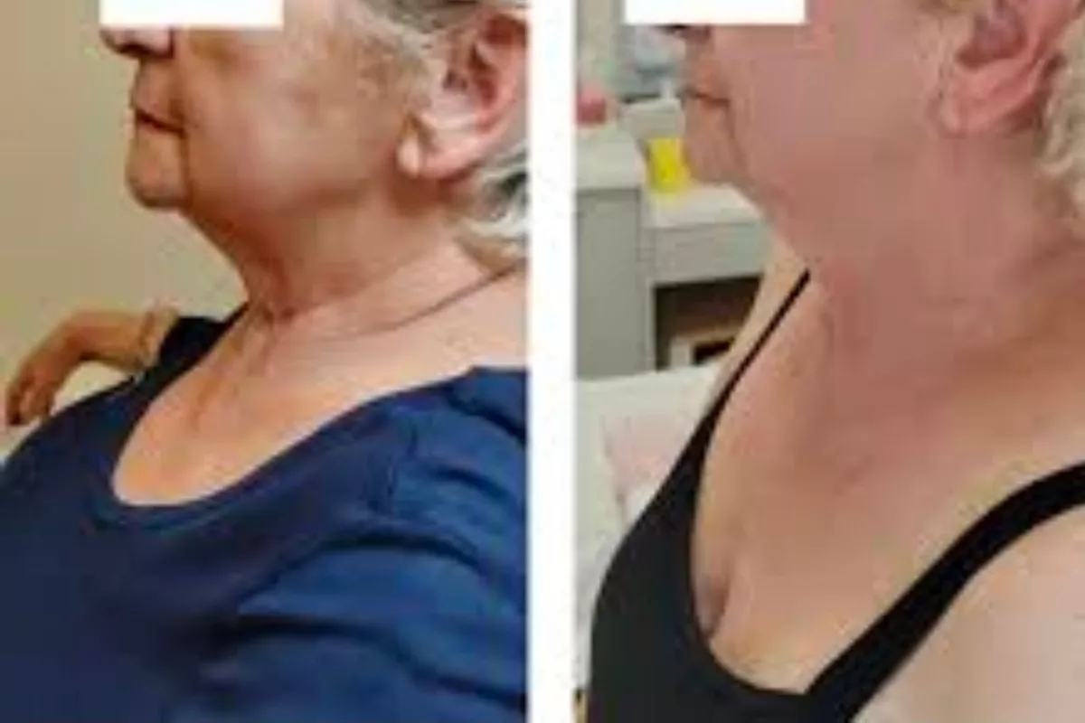 INDIBA – Rajeunissement de la peau du visage  (6 séance)