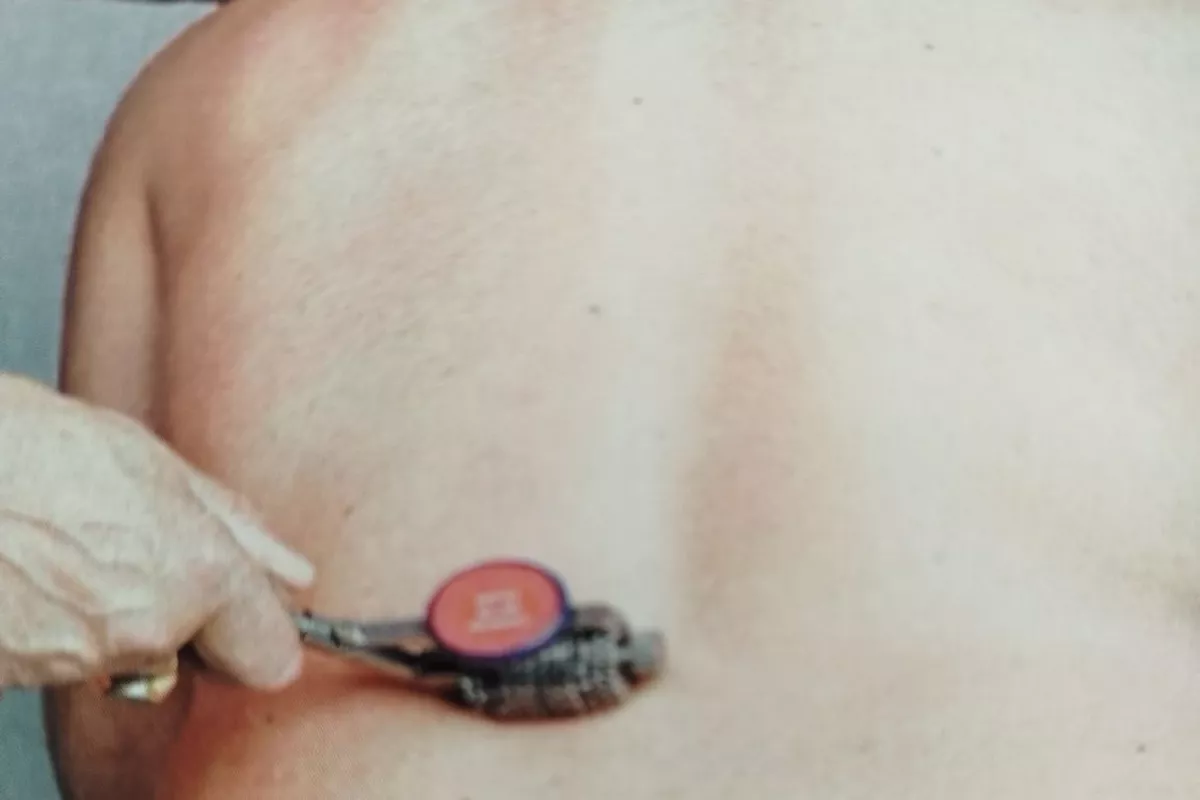 STP- Stimulation Transcutanée Ponctuelle