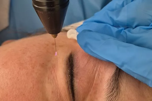 Plasma Froid méthode russe Contour des yeux + paupières