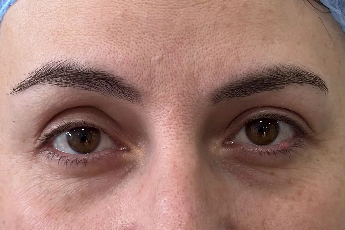 MICROSHADING - MICROPIGMENTATION DESOURCILS