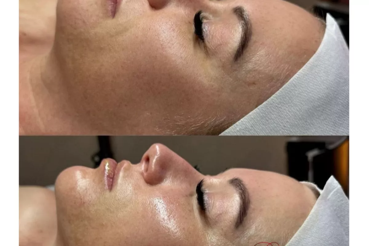 Hydrafacial Anti-Âge – Soin visage anti-rides