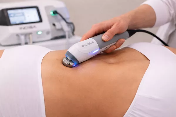 INDIBA – Rajeunissement de la peau du corps (selon zone)