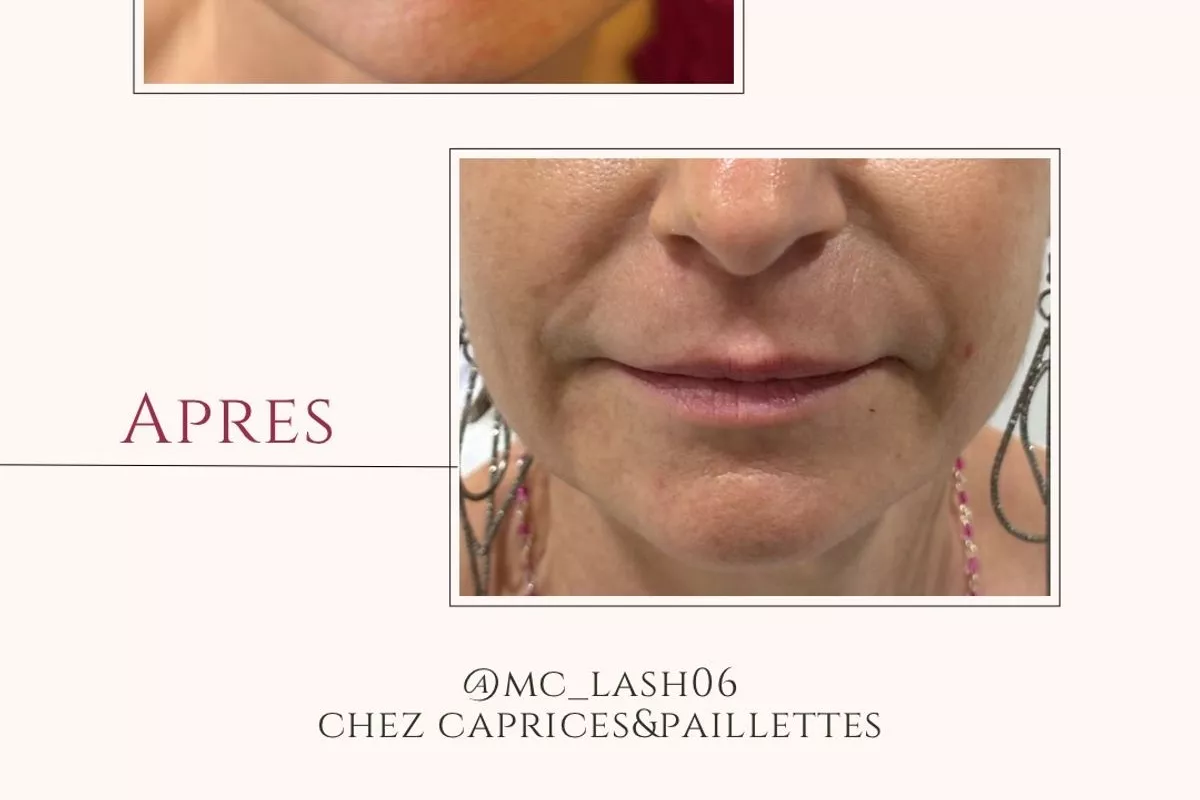 Plasma lift visage
