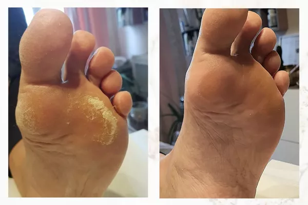 Soin anti callosité calluspeeling + pédicure express