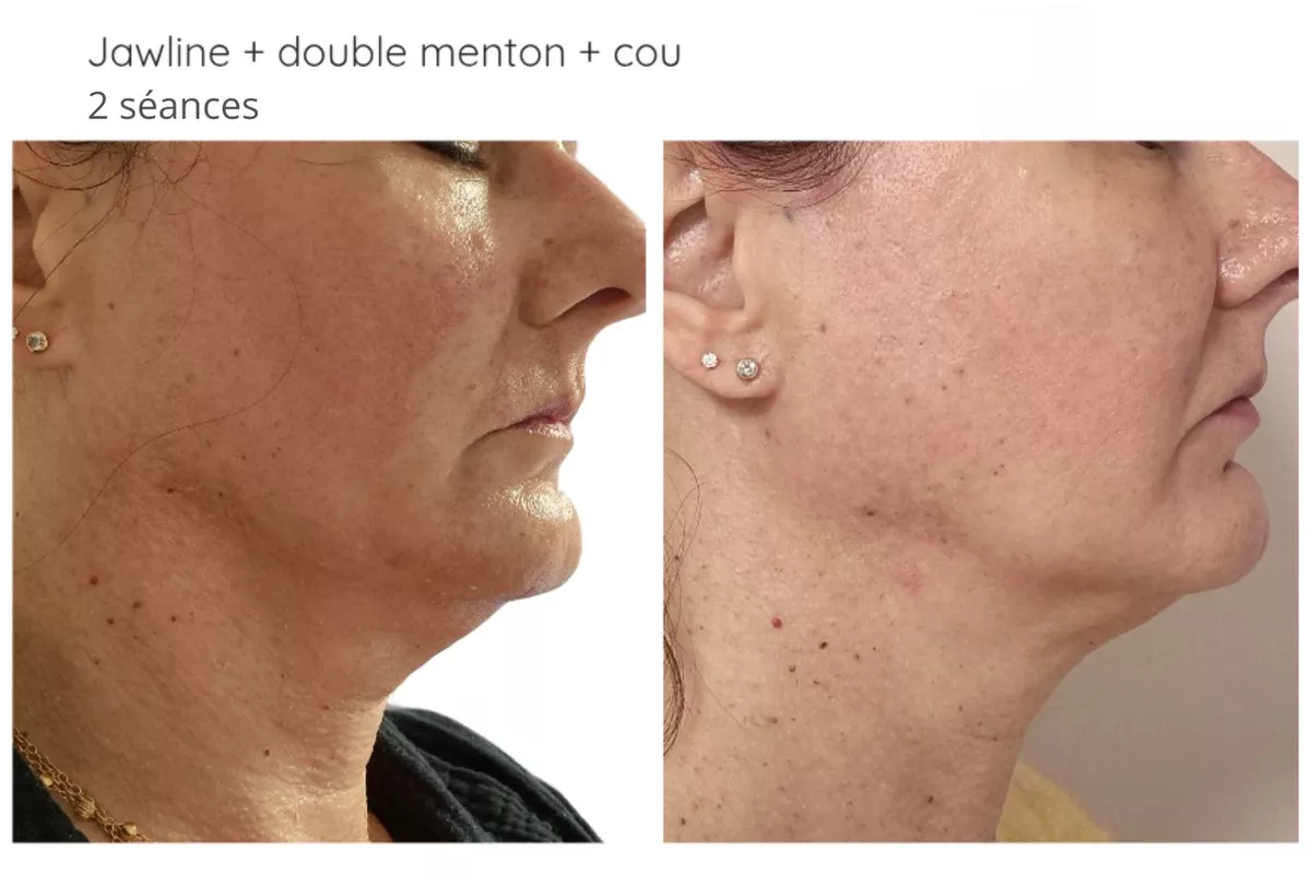 Plasma Froid Russe cou + double menton