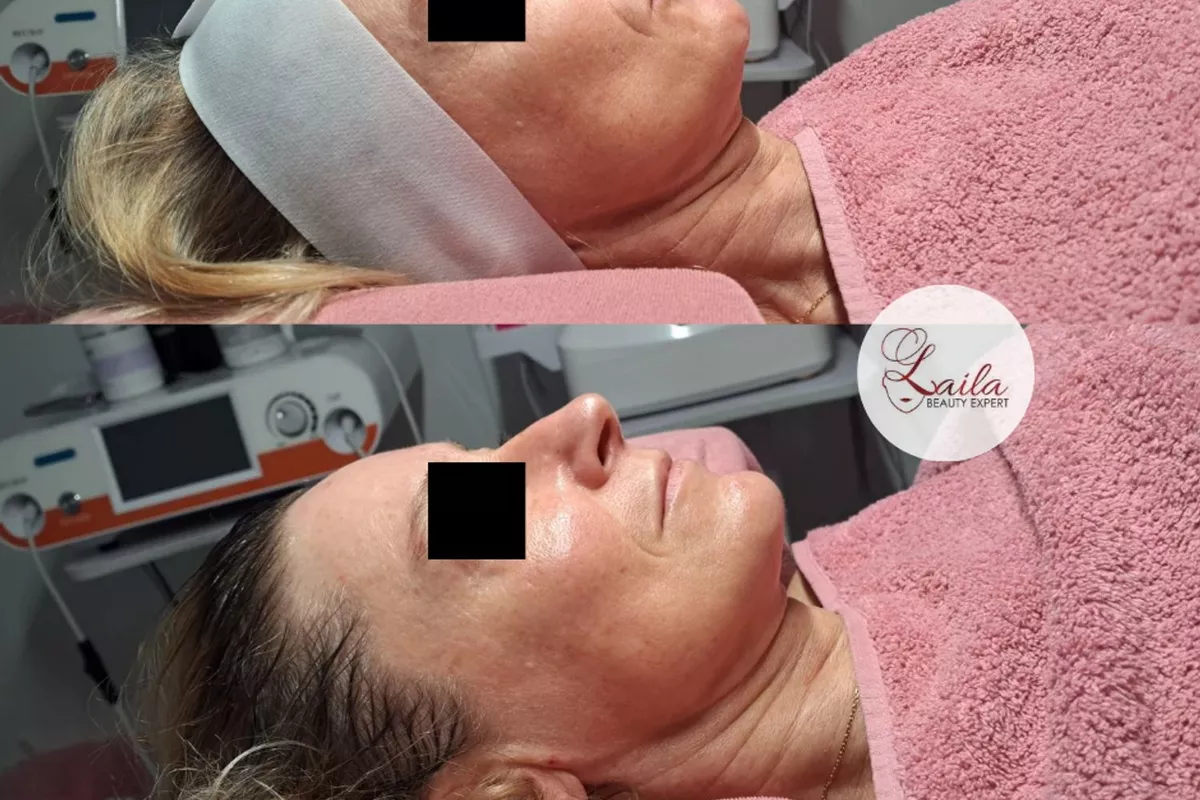 Peeling dépigmentant Bois-Guillaume