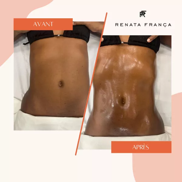 Affiner la taille et le vente avec le drainage lymphatique