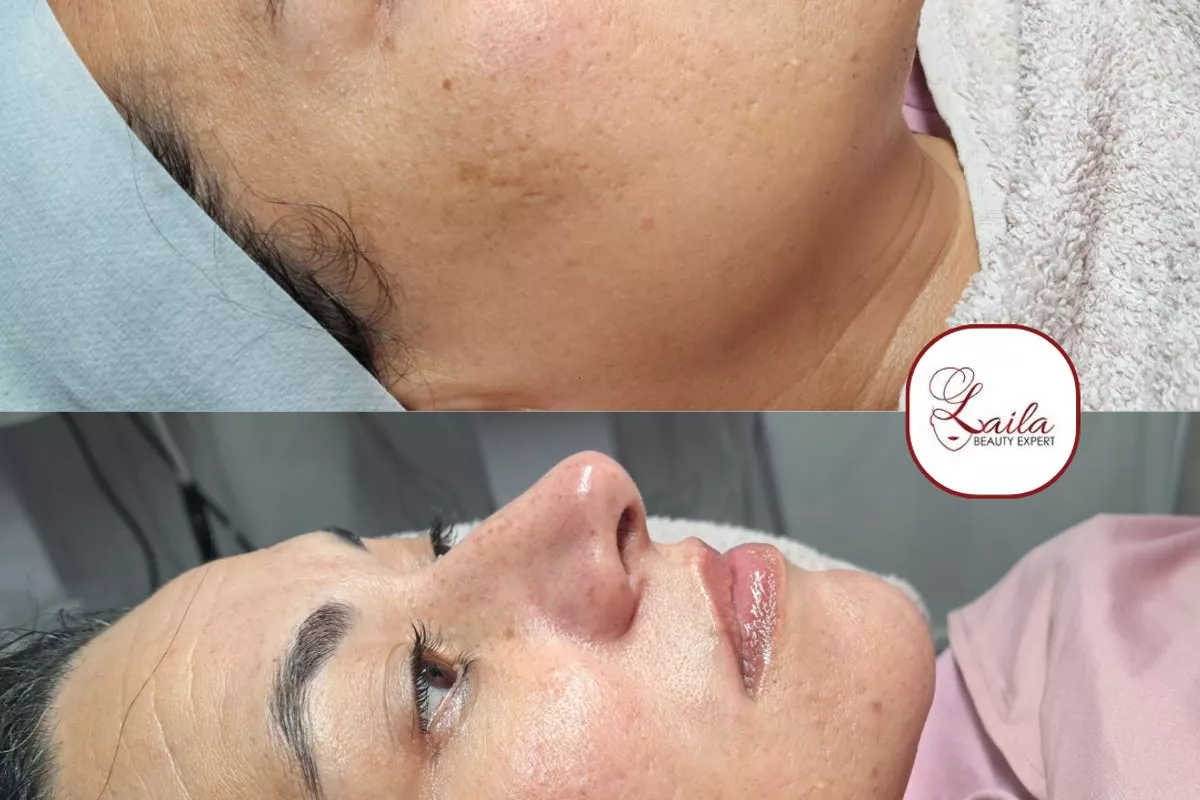 Épilation définitive au laser diode indolore Bois-Guillaume