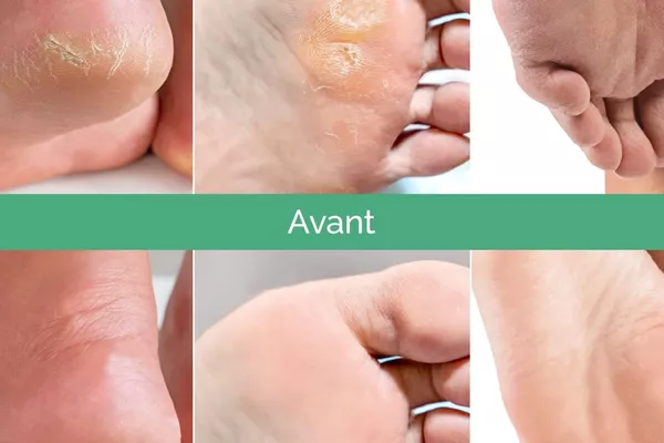 peeling des pieds
