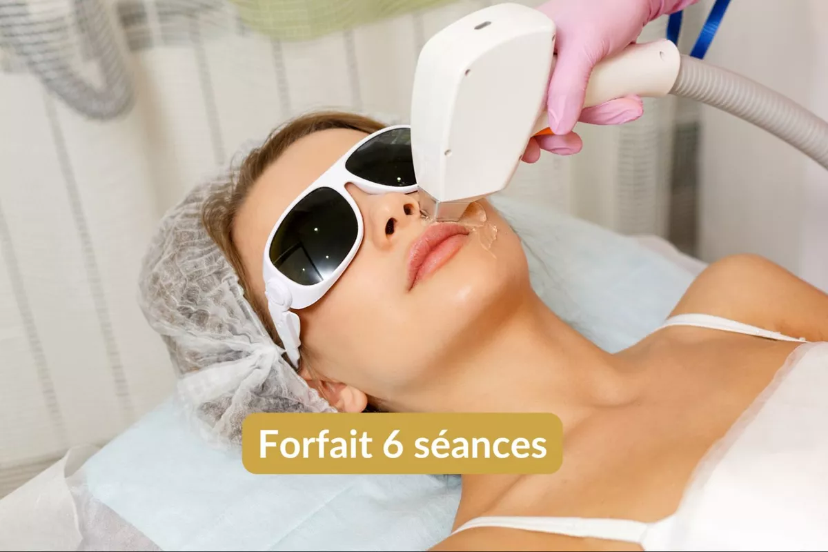 Épilation lumière pulsée Lèvre supérieure - Forfait 6 séances