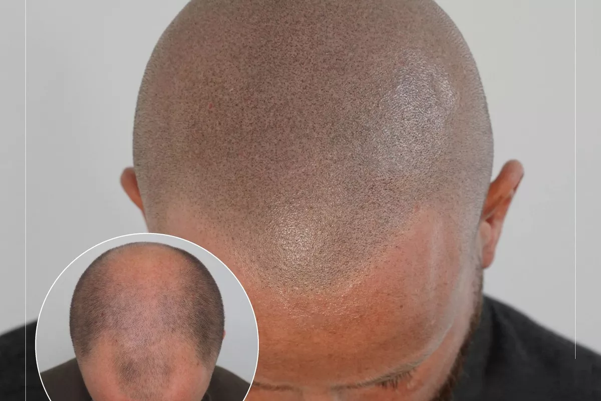 CAPILAIRE OU TRICOPIGMENTATION