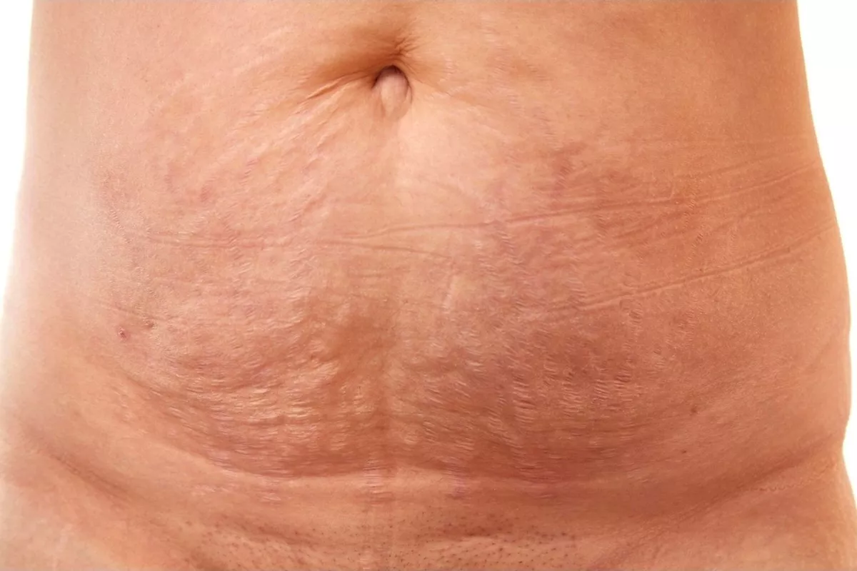 Royal Microneedling Vergetures – Abdomen
