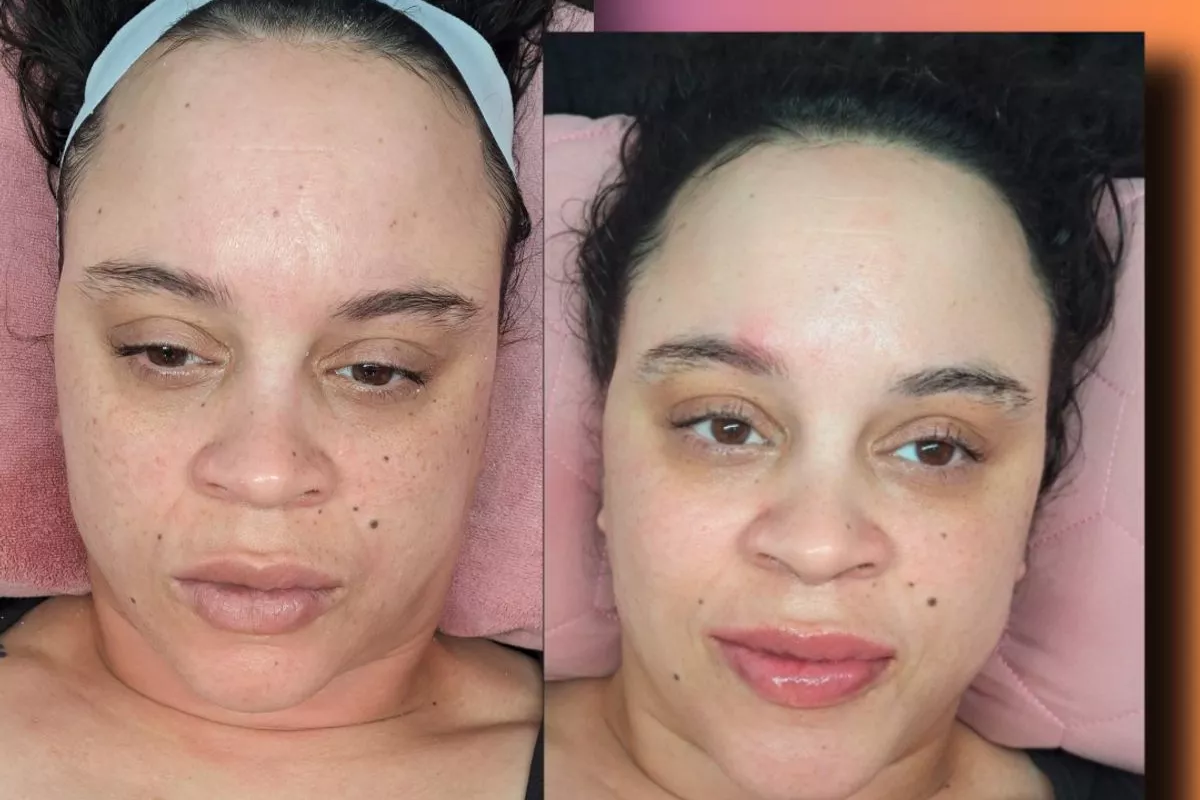 Microdermabrasion Bois-Guillaume