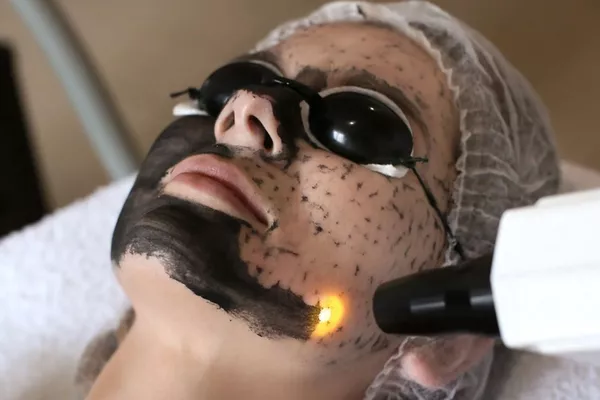 Soin du visage – Le Carbon Laser Peel (Hollywood)