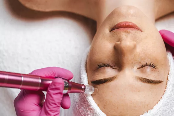 Microneedling Anti-Taches