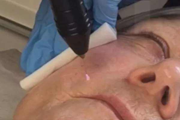 Plasma Froid méthode russe Visage complet (hors jawline et double menton)
