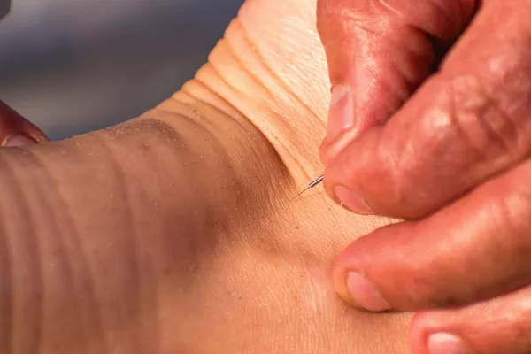 Séance d'acupuncture