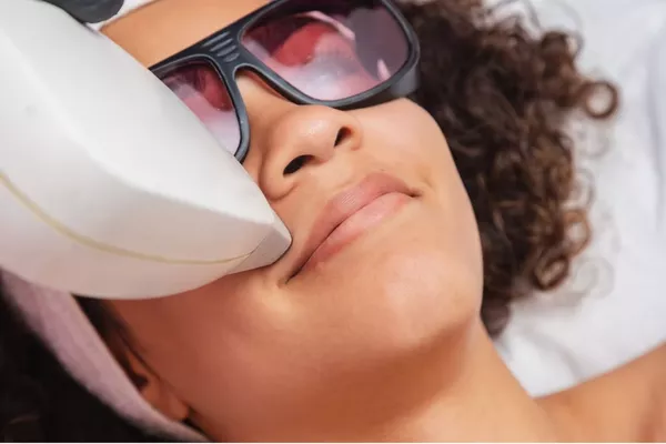 Épilation Laser - Lèvre supérieure