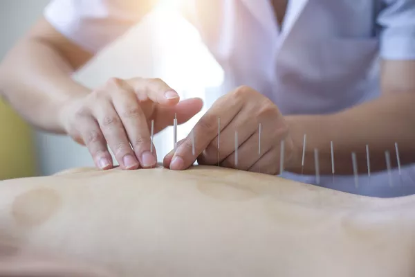 Séance d'acupuncture