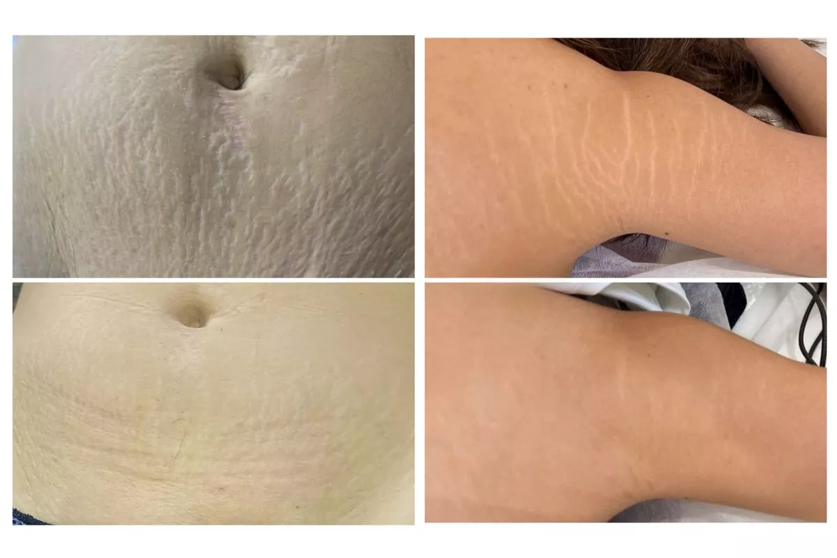 Skin Correct Vergeture - forfait 4 séances - 2 zones