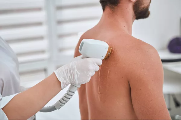 Épilation Laser Homme - Dos