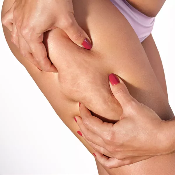 Cellu M6 avis : résultats et tarifs des soins minceur LPG contre la cellulite