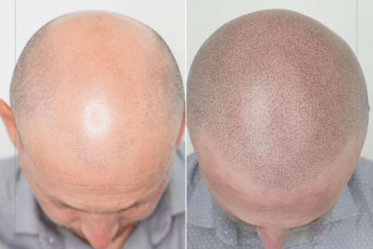 CAPILAIRE OU TRICOPIGMENTATION