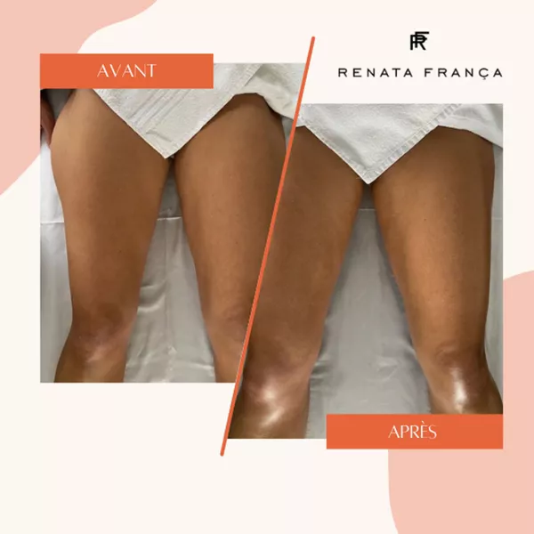 Jambes legères avec le drainage lymphatique