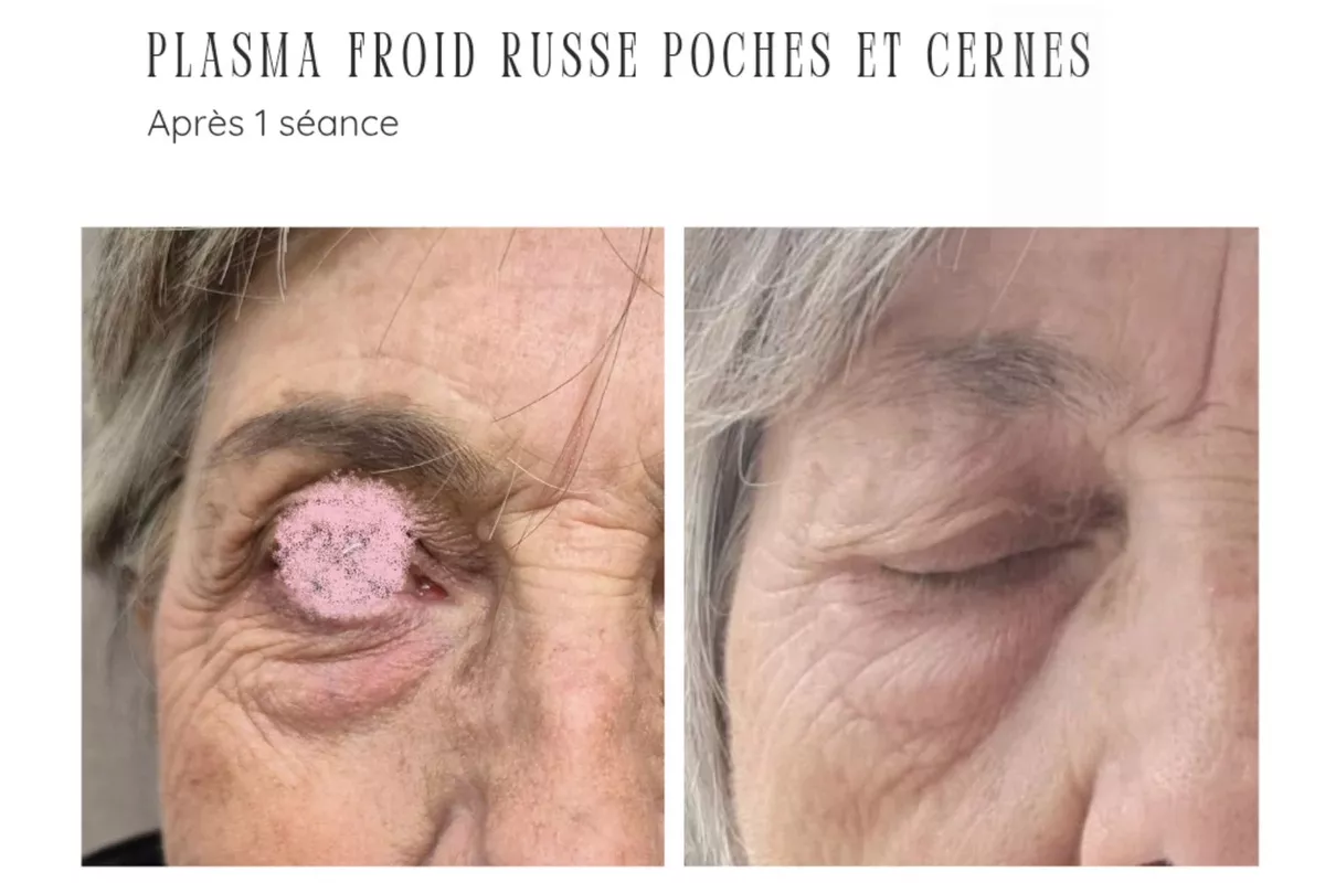 Plasma Froid Russe visage 1 zone (hors paupières)