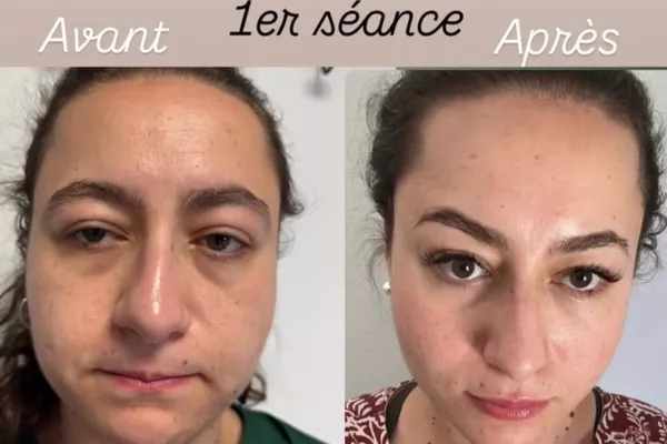 Plasma froid - lifting des paupieres